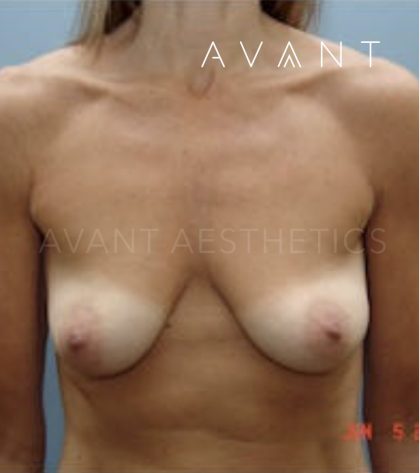 Breast Augmentation Before & After Patient #647
