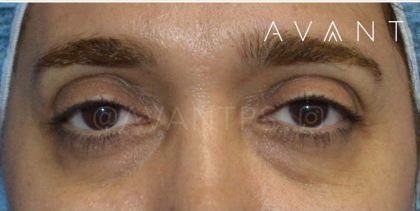 Lower Blepharoplasty Before & After Patient #640
