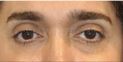 Lower Blepharoplasty Before & After Patient #640
