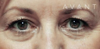 Lower Blepharoplasty Before & After Patient #641