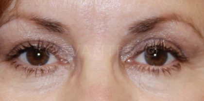 Lower Blepharoplasty Before & After Patient #641