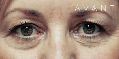 Blepharoplasty Before & After Patient #642
