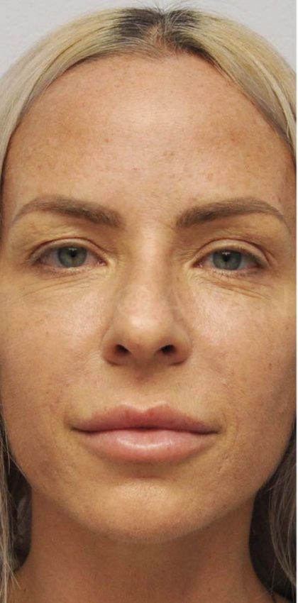 Botox Before & After Patient #675