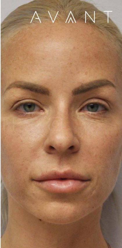 Botox Before & After Patient #675