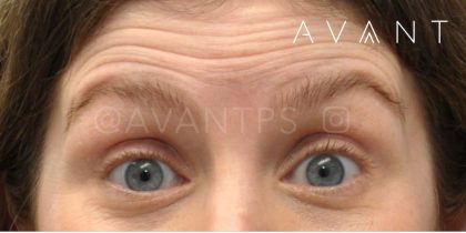 Botox Before & After Patient #676