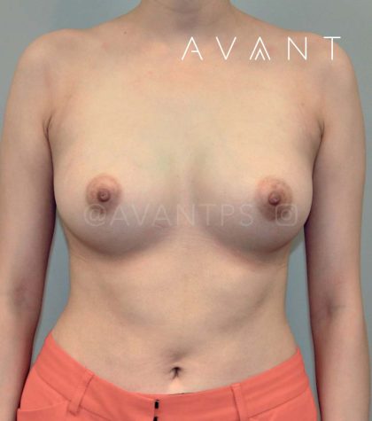 Breast Augmentation Before & After Patient #643