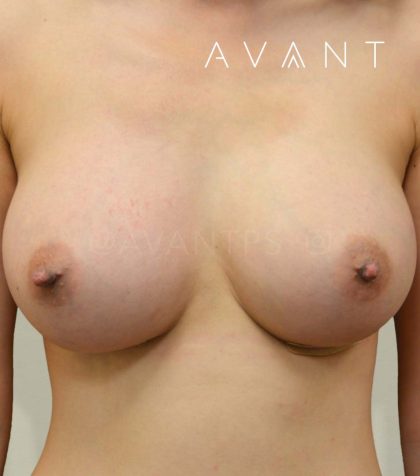 Breast Augmentation Before & After Patient #644