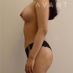 Breast Augmentation Before & After Patient #645