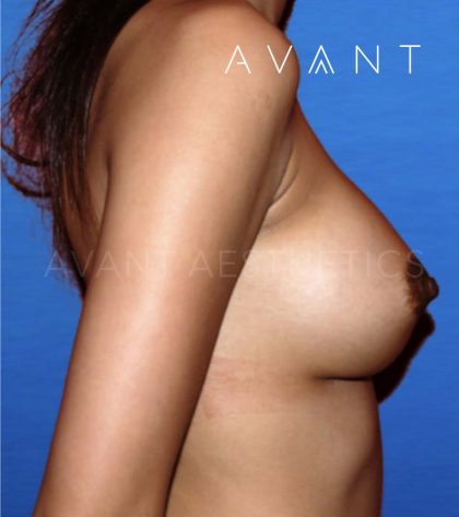 Breast Augmentation Before & After Patient #646