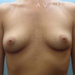 Breast Augmentation Before & After Patient #648