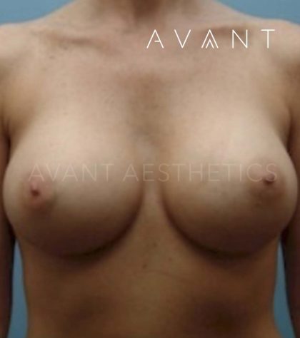 Breast Augmentation Before & After Patient #648