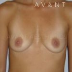 Breast Augmentation Before & After Patient #649