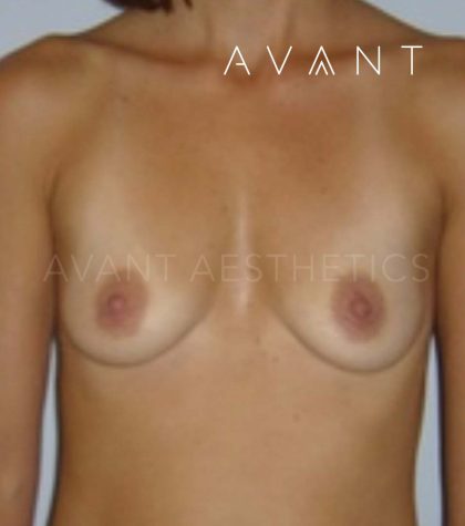 Breast Augmentation Before & After Patient #649