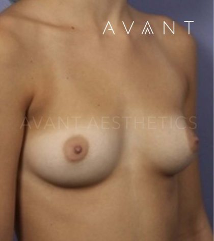 Breast Augmentation Before & After Patient #651