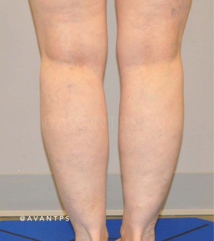Calf Augmentation Before & After Patient #656