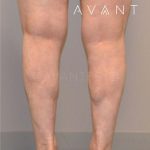 Calf Augmentation Before & After Patient #656