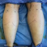 Calf Augmentation Before & After Patient #657