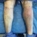 Calf Augmentation Before & After Patient #657