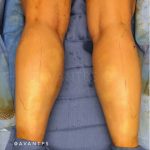 Calf Augmentation Before & After Patient #658