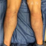 Calf Augmentation Before & After Patient #658