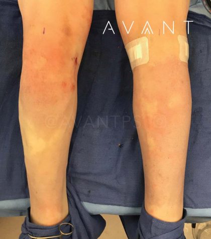 Calf Augmentation Before & After Patient #659