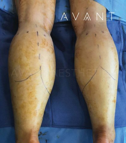 Calf Augmentation Before & After Patient #660