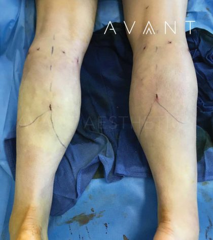 Calf Augmentation Before & After Patient #660