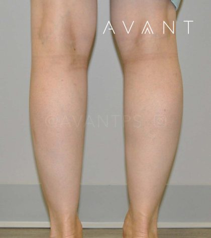 Calf Augmentation Before & After Patient #663