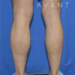 Calf Augmentation Before & After Patient #664