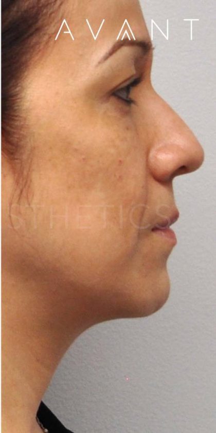 Fillers Before & After Patient #680