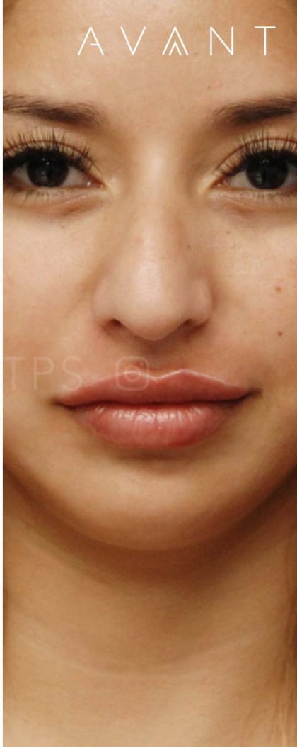 Fillers Before & After Patient #695