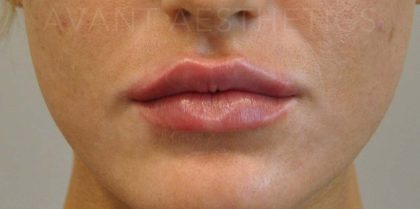 Fillers Before & After Patient #693