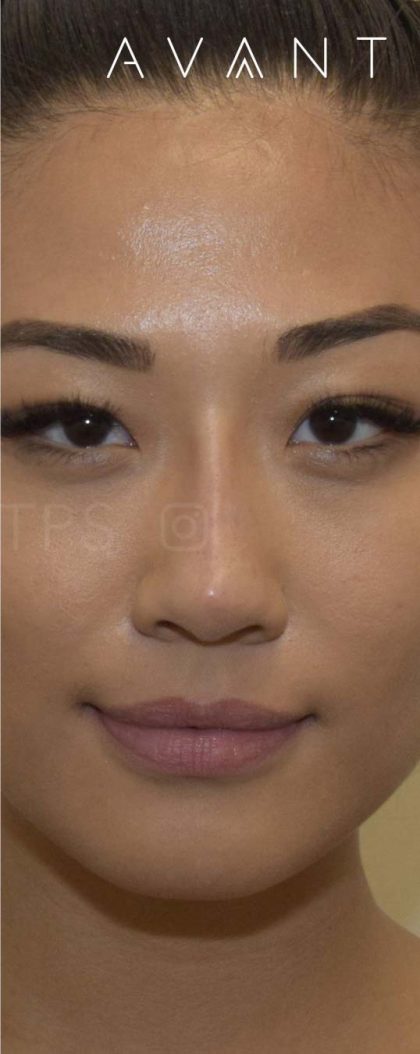Fillers Before & After Patient #698