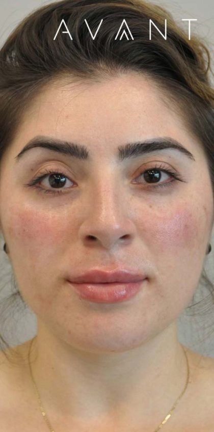 Fillers Before & After Patient #700