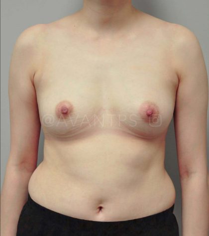 Liposuction Before & After Patient #667