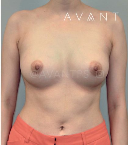 Liposuction Before & After Patient #667