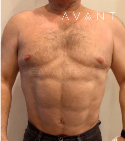 Liposuction Before & After Patient #670