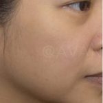 Thermage FLX Before & After Patient #705