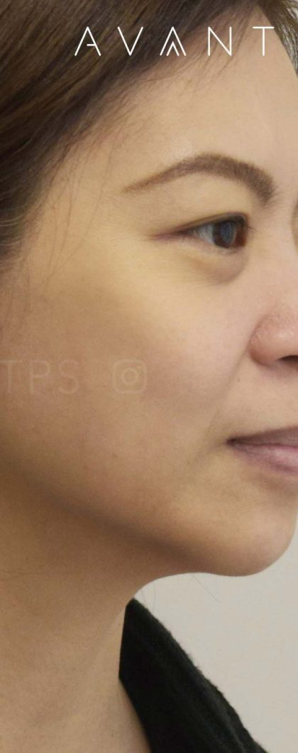 Thermage FLX Before & After Patient #705