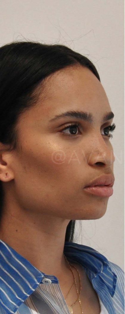 Threadlift Before & After Patient #707