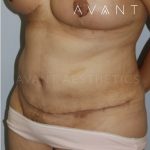 Tummy Tuck Before & After Patient #671