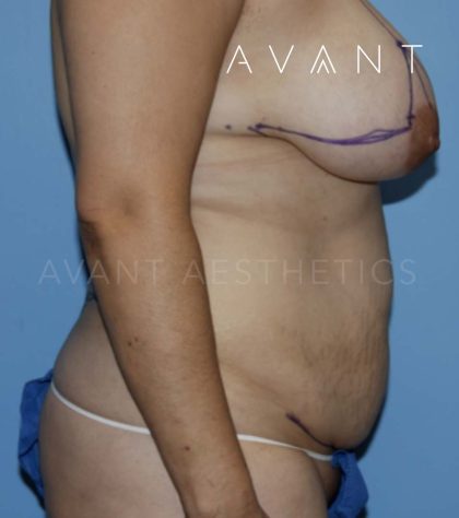 Tummy Tuck Before & After Patient #671
