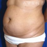 Tummy Tuck Before & After Patient #672