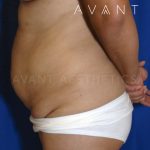 Tummy Tuck Before & After Patient #672